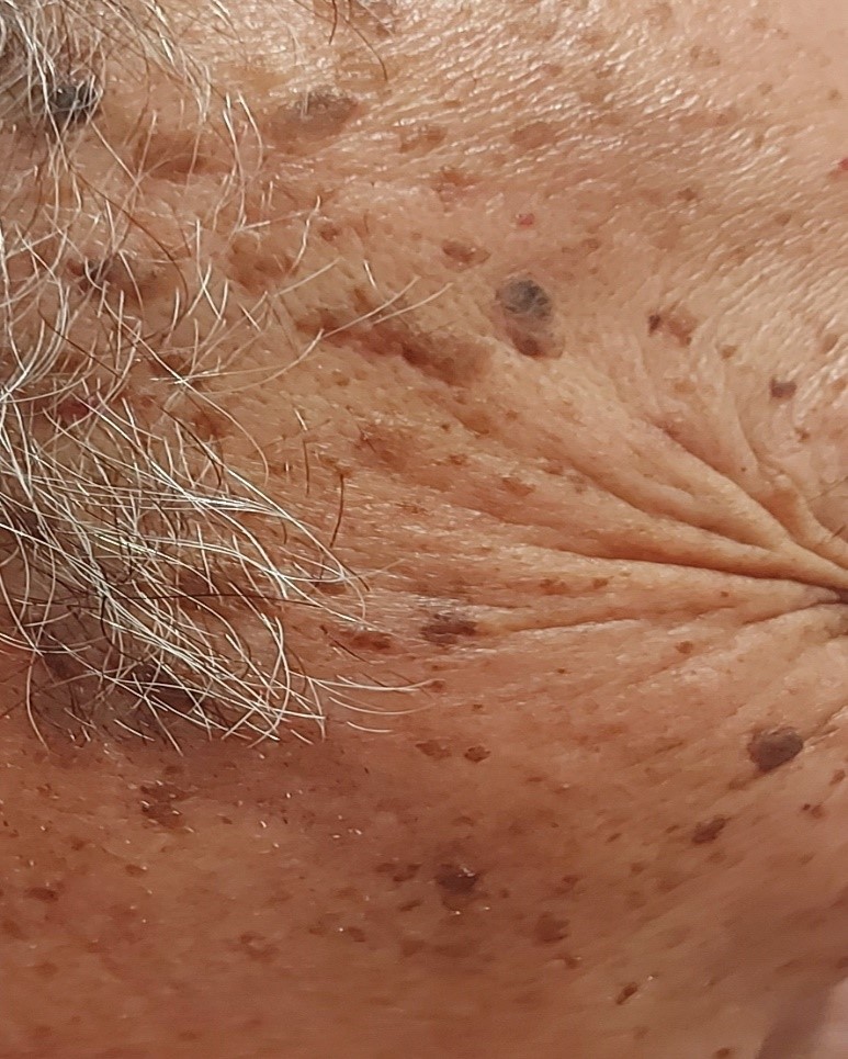 lesiones-cutaneas04